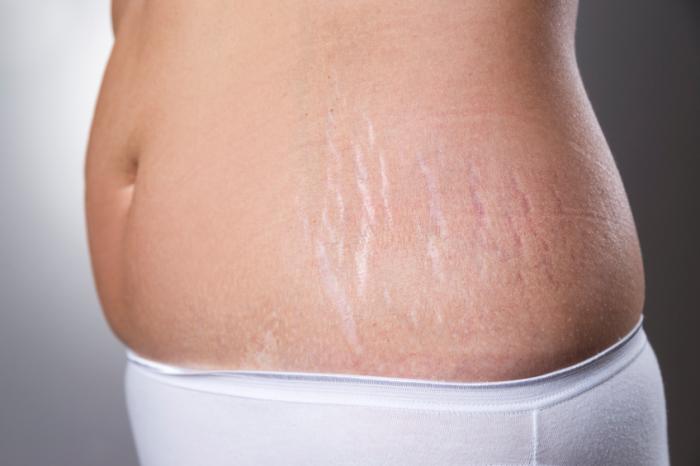 stretch-marks-on-tummy